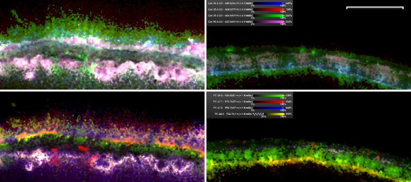 Spatial lipidomics in murine psoriatic skin. 