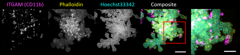 Breast cancer organoid with infiltrated macrophages. 