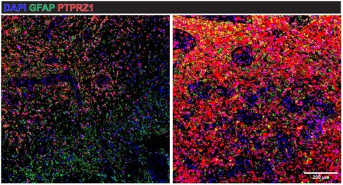 Figure: PTPRZ1 protein expression in primary tumor